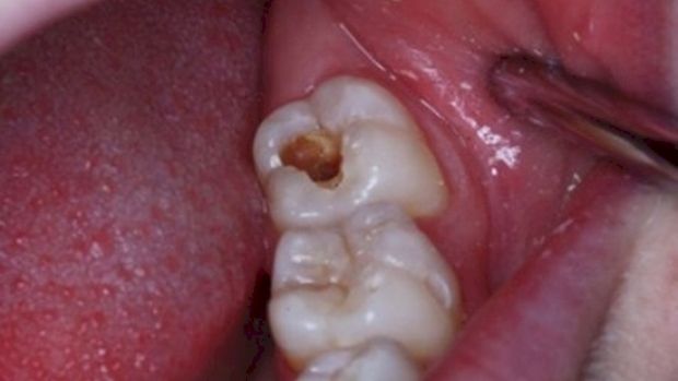 Fabulos! Cum poţi vindeca o carie fără să mergi la dentist! Ce ai de făcut