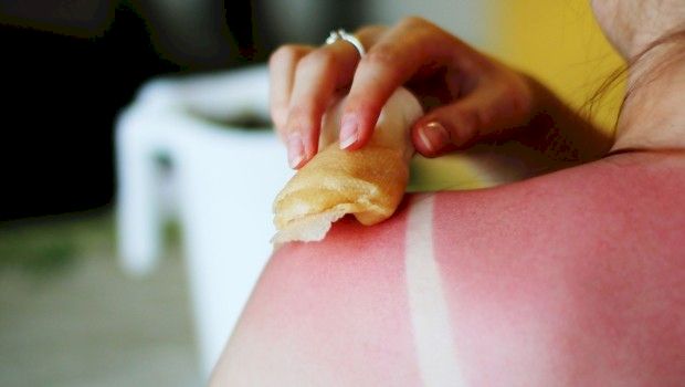 Te-a ars soarele? Iată cele mai bune remedii naturale împotriva arsurilor solare