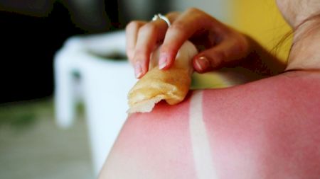 Te-a ars soarele? Iată cele mai bune remedii naturale împotriva arsurilor solare