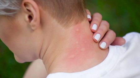 Top 5 metode naturale de a ține țânțarii la distanță. Care sunt sfaturile doctorului Oana Cuzino