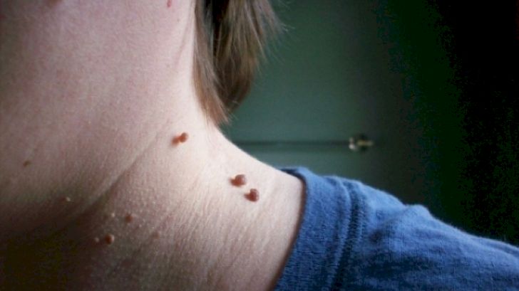 Scapă rapid de alunițe și negi: Iată remediul natural care a ajutat mii de români