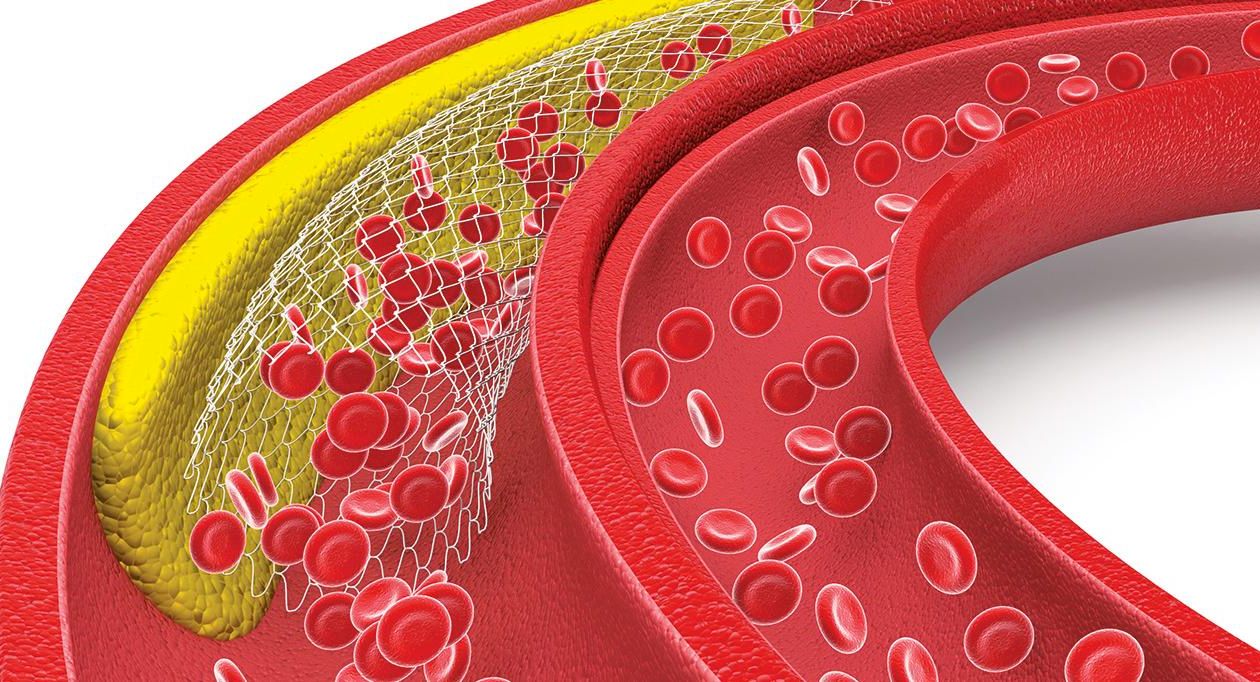 Alimentul care poate înfunda arterele. La scurt timp apar probleme cardiace