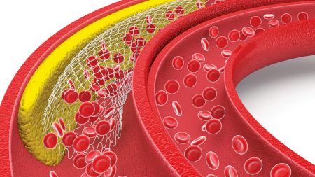Alimentul care poate înfunda arterele. La scurt timp apar probleme cardiace